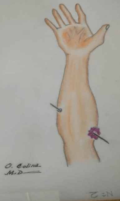 Figura 3. Vista anterior del antebrazo derecho. Orificio de entrada y orificio de salida del proyectil. (Ilustración realizada por el Dr. Oscar Colina según indicaciones del autor. Caracas, 2025.)