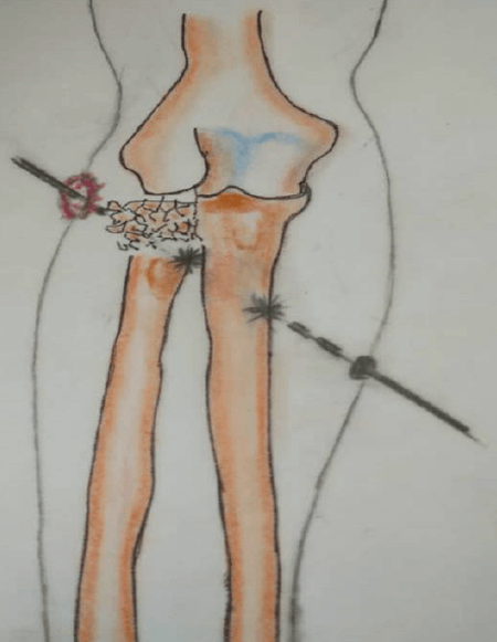 Figura 4. Vista anterior del antebrazo derecho. Lesiones óseas producidas por el proyectil. (Ilustración realizada por el Dr. Oscar Colina según indicaciones del autor. Caracas, 2025.)