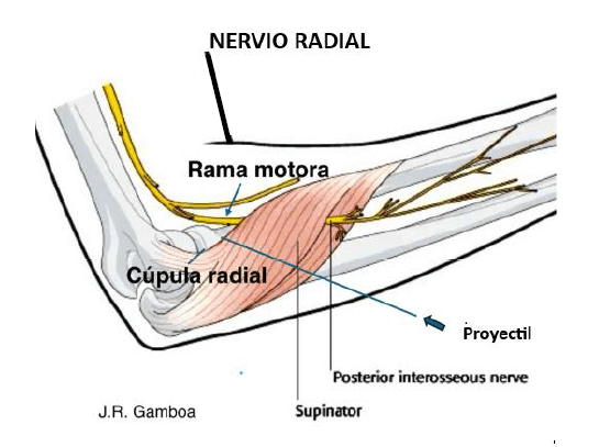 Figura 6. Relación del nervio radial con los elementos del codo y el trayecto del proyectil