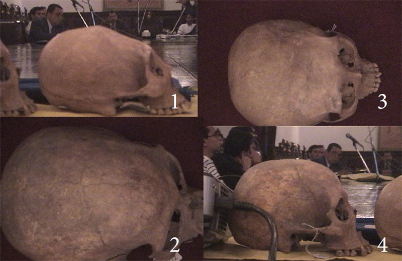 Tabular Masculino: 1 y 2 Normal Masculino 3 y 4 Deformaciones craneanas voluntarias. Lago de Valencia (entre los estados Carabobo y Aragua, descubierto por Juan de Villegas en 1547). Venezuela.