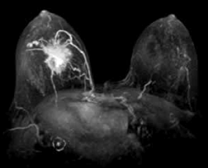 Figura 6. Imagen de resonancia magnética donde se evidencia la vascularidad y la impregnación de contraste de una lesión tumoral