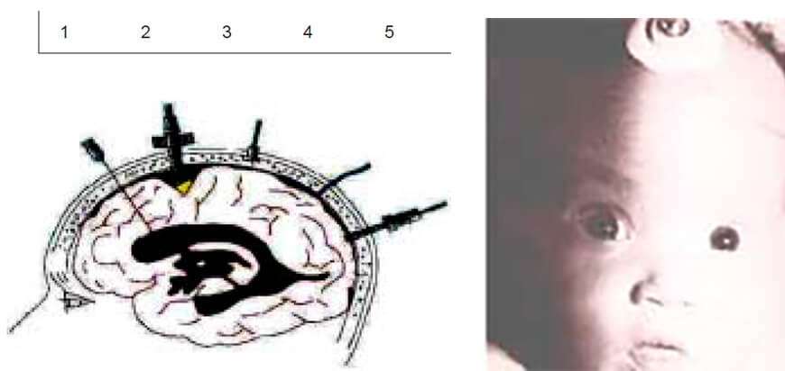 Figura 4. Se observa las diferentes localizaciones de los monitores: 1 intraventricular, no costoso y con ventaja de drenaje de LCR. 2-4-5- localizaciones aracnoideas y 3 epidural. El camino puede ubicarse en diferentes localizaciones y a la derecha el sensor Ladd en fontanelas permeables.