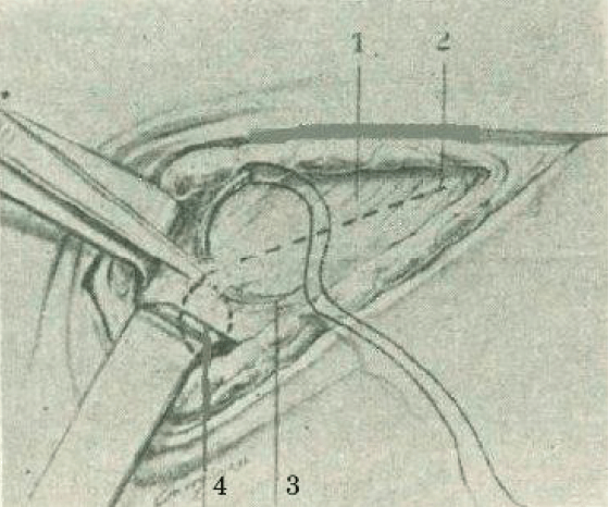 Figure 2. Section of the aponeurosis of the external oblique muscle of the abdomen with the inguinal protection point of A. Grimaldi. 1- Aponeurosis of the external oblique muscle of the abdomen 2.- Layout of the aponeurotic section. 3.- Protection point of the inguinal canal 4.- Deep opening of the inguinal canal below and in front of the previous point.