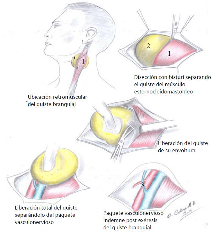 1.Músculo esternocleidomastoideo 2.Quiste branquial 3.Paquete vasculonervioso