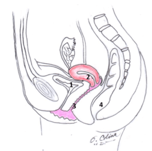 Fig. 1. Anatomía normal. 1. Vejiga 2. Útero 3. Vagina 4. Colon