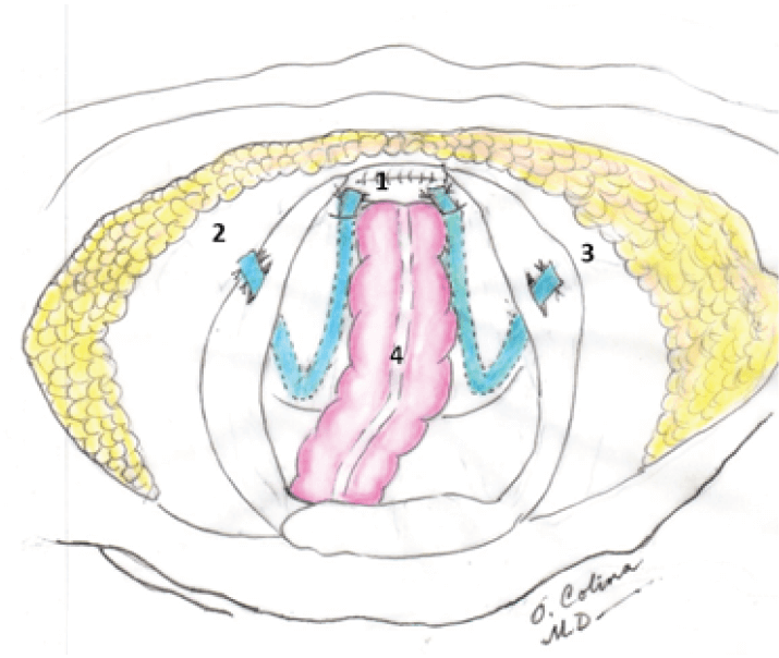 Fig. 5. Operación finalizada (vista superior) 1. Cúpula vaginal 2 y 3. Tiras de malla a través de túneles retroperitoneales 4. Colon sigmoides y recto