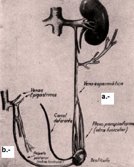 Figura 1. Esquema de la publicación de Ivanissevich que muestra los dos grupos venosos fundamentales que drenan la sangre venosa del testículo izquierdo: a.- El grupo anterior, localizado dentro del cordón espermático, drena en la vena testicular izquierda, b.- El grupo posterior, localizado por detrás del cordón espermático, drena en la vena epigástrica. (21)
