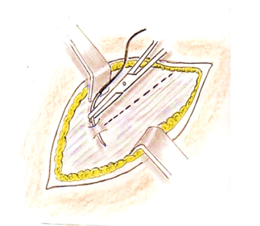 Figura 3. Exposición de la aponeurosis del Oblicuo externo y colocación de un punto de protección del conducto inguinal (punto de Grimaldi).