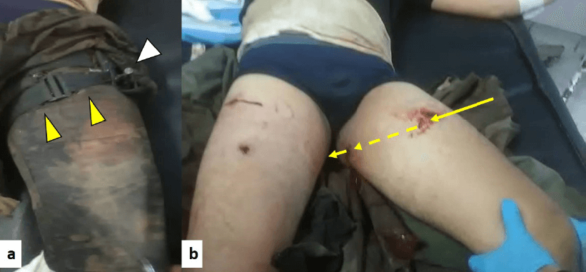 Figura 3. Imágenes de paciente perteneciente a un cuerpo de seguridad, quien sufrió heridas penetrantes por arma de fuego en miembros inferiores, sometido a maniobra hemostática prehospitalaria con el uso de torniquete, atendido por el autor en el centro hospitalario. a. Torniquete en área de compresión. Puntas de flechas amarillas, brazalete compresor sobre el tercio superior del muslo izquierdo. Punta de flecha blanca, manubrio del torniquete. b. Exposición del área de la lesión en muslo izquierdo posterior a retiro de torniquete y vestiduras. Flecha amarilla, trayectoria del proyectil percutido por arma de fuego en el muslo izquierdo.