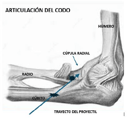 Figura 5. Articulación del codo. Trayecto del proyectil