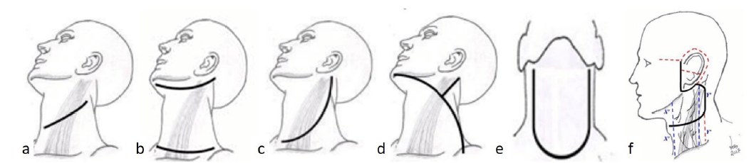 Figura 2. Esquema de heridas quirúrgicas usadas para disecciones ganglionares de cuello. a. Atti o única transversa. b. Doble de Garriga c. Palo de Hockey. d. Schobinger o modificado de Conley. e. Delantal. f. Incisión cérvicofacial de colgajo superior adaptable, ICFCSA.