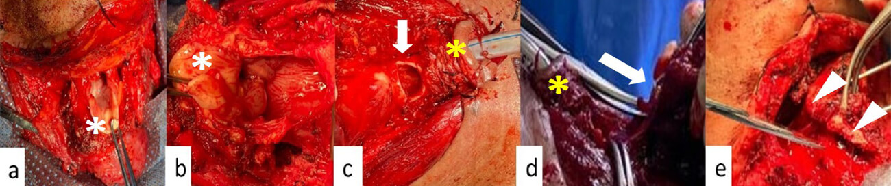 Figura 1. Maniobras quirúrgicas clásicas para la realización de las laringectomías totales. a y b. Gluck o anterógrada descendente. Asterisco blanco, epiglotis. Apertura de la vía digestiva por el margen superior del hueso hioides y extirpación sobre el borde superior supraglotico. c y d. Perier o retrograda descendente. Flecha blanca, tráquea. Asterisco amarillo, traqueostomía previa. Apertura de la tráquea y ascenso de la disección por su cara posterior hasta la faringe. e. Tapia. Punta de flecha blanca, borde externo del cartílago tiroides. Despegue de la pared externa de la vía digestiva del interior del cartílago tiroides.
