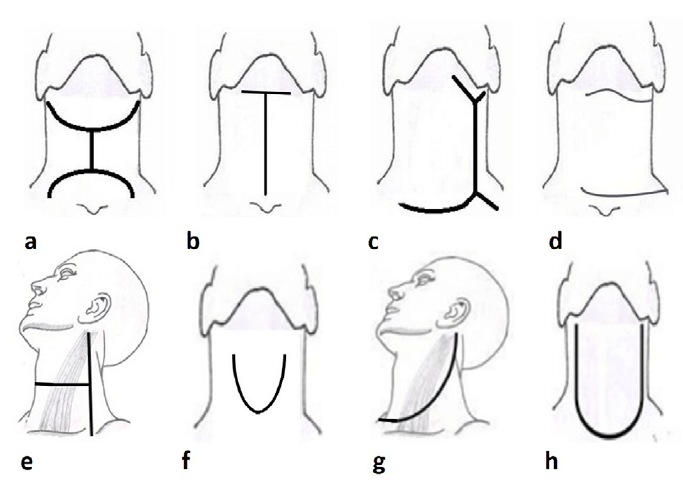 Figura 3. Incisiones quirúrgicas clásicas y contemporáneas usadas para las laringectomías totales. a) Incisión en “H invertida” o de Perier. b) Línea vertical media o de Portmann. c) Doble Y de Hayes Martin con extensión para laringectomía. d) Colgajo puente o de Garriga. Ambos trazos sobrepasan la línea media anterior. e) Media H o de Kambic & Sirca. f) Copa o de Gluck. g) Eckert & Byers o en palo de Hockey, con extensión contralateral. h) Delantal. Esquema propio del autor.