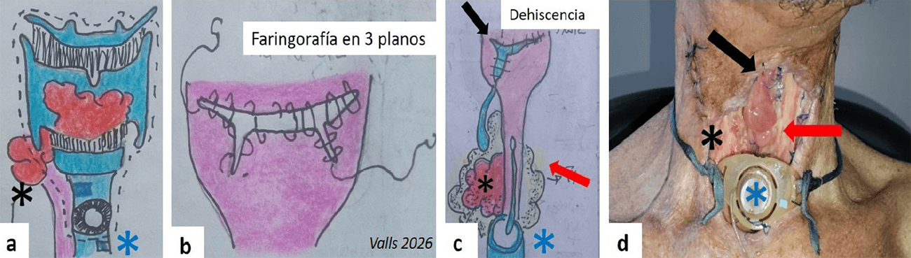Figura 4. Ilustraciones e imagen de paciente sometido a laringectomía de rescate que presento distintas complicaciones. Asterisco negro, tumor que invade tejidos extralaríngeos. Asterisco azul, traqueostomía permanente. Flecha negra y roja, fistula faringocutanea y esofágica, respectivamente. a. Laringectomía de salvamento por tumor persistente posterior a protocolo preservador de quimioterapia y radioterapia. Durante su realización se identifica progresión de la neoplasia a esófago cervical y vasos principales. b. Faringorafía de difícil ejecución. c y d. Dos semanas después de la intervención, desarrolla fistula faringocutanea en el cierre de la vía digestiva. Fistula esofágica puntual espontanea.