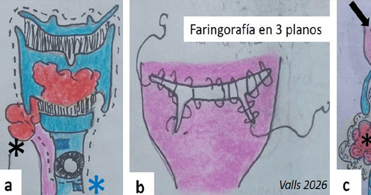 Experiencia en laringectomias totales de intención primaria y de rescate