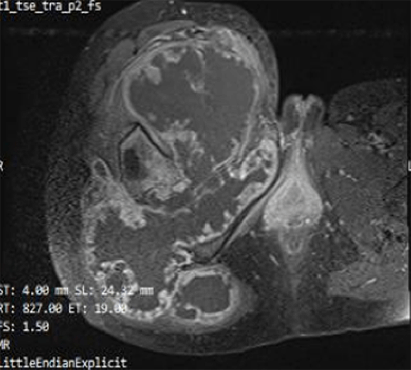 Imagen 3. RMN corte axial en secuencia T1