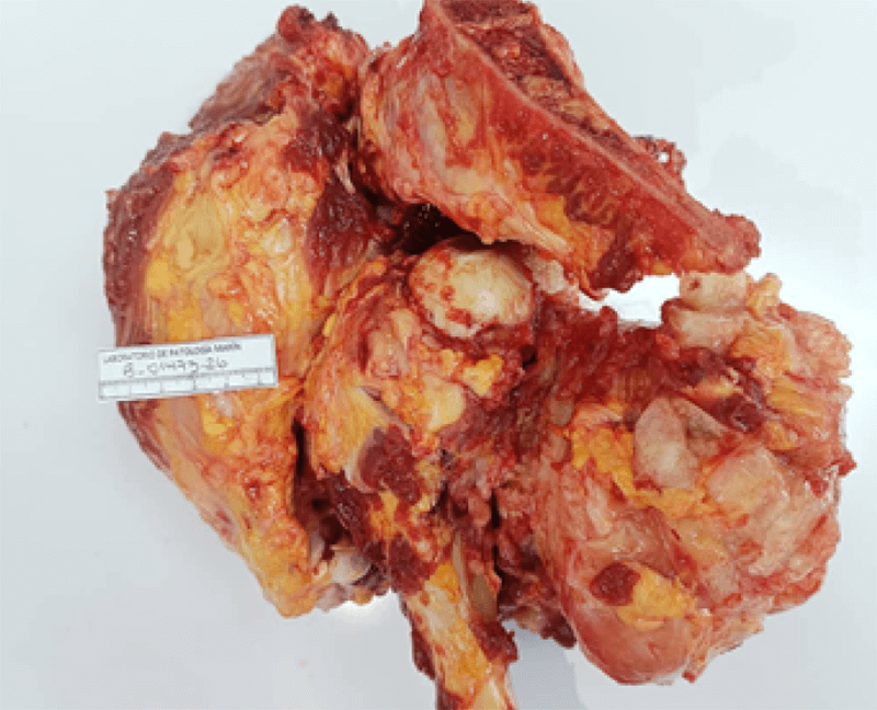 Imagen 6. Lesión de aspecto osteocondromatoso en metáfisis proximal de fémur.